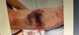 Pitbull ataca e dilacera perna de idoso de 73 anos em rancho 