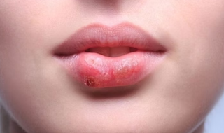 Alerta no Carnaval: beijo pode transmitir doen&ccedil;as durante bloquinhos