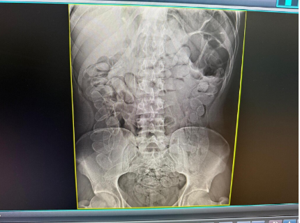 Boliviana &eacute; presa sete dias com 90 c&aacute;psulas de coca&iacute;na no est&ocirc;mago