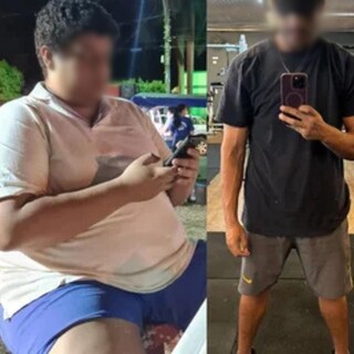 Obesidade e lipedema t&ecirc;m tratamento; diagn&oacute;stico precoce ajuda
