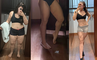 Obesidade e lipedema t&ecirc;m tratamento; diagn&oacute;stico precoce ajuda