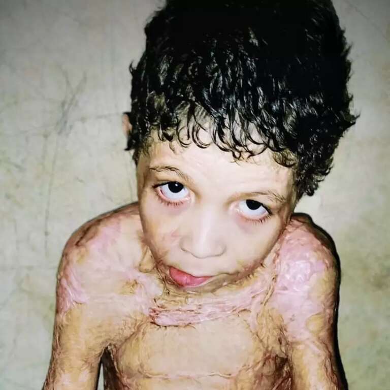 Após explosão, sonho de menino é “voltar ao normal e estudar”