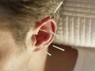 Nutricionistas passam a poder aplicar acupuntura como apoio ao tratamento Nutricionistas passam a poder aplicar acupuntura como apoio ao tratamento