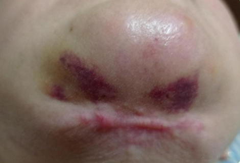 Paciente ser&aacute; indenizada por deformidades no rosto ap&oacute;s cirurgias 