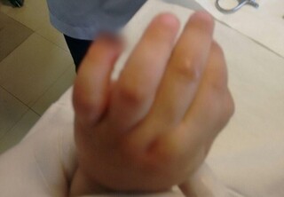 Sobe para R$ 25 mil indeniza&ccedil;&atilde;o por crian&ccedil;a que teve dedo amputado em Emei