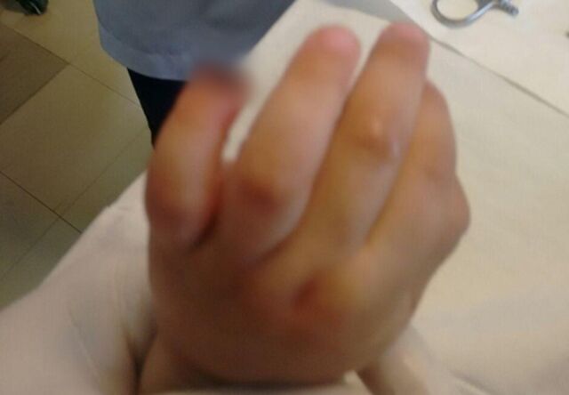 "Sobe para R$ 25 mil indenização por criança que teve dedo amputado em Emei"