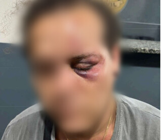 &ldquo;Achei que iam me matar&rdquo;, diz mulher trans espancada e marcada com su&aacute;stica