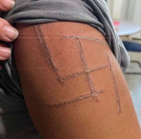 &ldquo;Achei que iam me matar&rdquo;, diz mulher trans espancada e marcada com su&aacute;stica