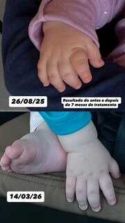 Ap&oacute;s recorrer &agrave; Justi&ccedil;a, m&atilde;es lutam por medicamento contra nanismo no SUS