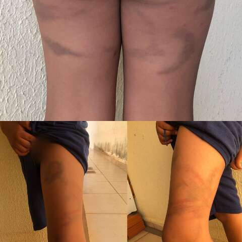 Pai &eacute; denunciado ap&oacute;s bater e entregar filho de 7 anos com hematomas &agrave; m&atilde;e