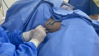 Na esperan&ccedil;a de voltar a andar, mais 2 pacientes recebem polilaminina na Capital