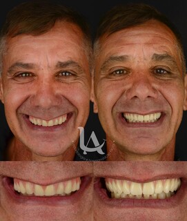 Fim do medo? Implante dent&aacute;rio ganha for&ccedil;a em Campo Grande