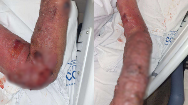 Pedreiro processa munic&iacute;pio ap&oacute;s quase perder bra&ccedil;o por erro m&eacute;dico