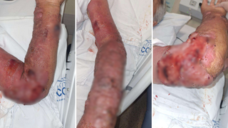 Pedreiro processa munic&iacute;pio ap&oacute;s quase perder bra&ccedil;o por erro m&eacute;dico