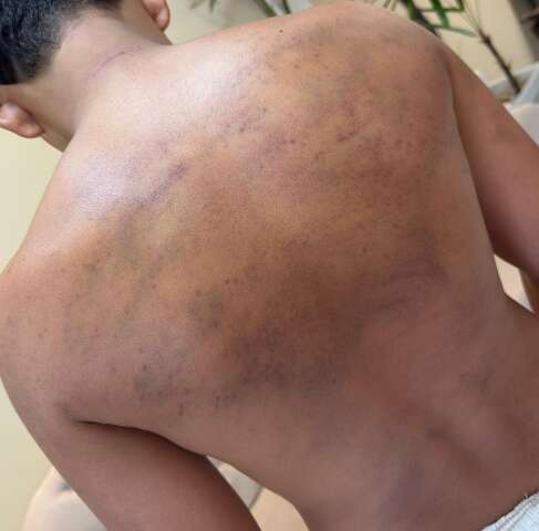 &ldquo;Corretivo&rdquo; em projeto social deixa adolescente ferido e fam&iacute;lia vai &agrave; pol&iacute;cia