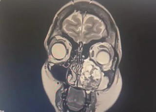 Nadielly achou que fosse sinusite, mas dor era c&acirc;ncer raro na bochecha