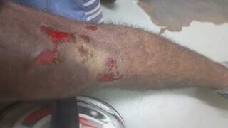 Motociclista de aplicativo e passageira ficam feridos ap&oacute;s ca&iacute;rem em &ldquo;cratera&rdquo;