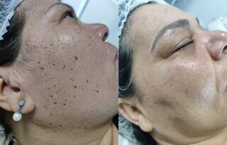 T&eacute;cnica exclusiva de Jozi Costa remove verrugas sem cicatrizes