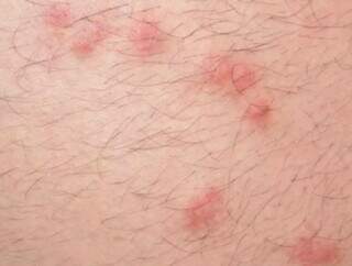 Familiar de paciente denuncia infesta&ccedil;&atilde;o de percevejos em CAPS do Centro