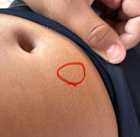 &ldquo;Falavam que eu era feia&rdquo;, diz crian&ccedil;a internada ap&oacute;s uso de caneta emagrecedora