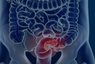 SUS adota teste de fezes para ampliar rastreio de câncer no intestino SUS adota teste de fezes para ampliar rastreio de câncer no intestino