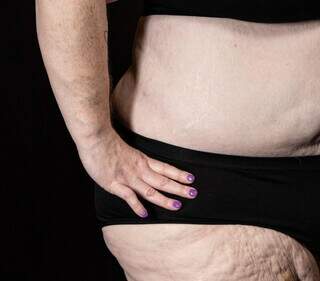 M&eacute;dicas e nutricionistas v&atilde;o falar sobre lipedema em evento gratuito na Capital