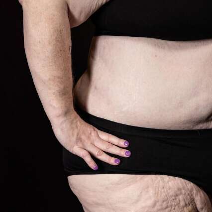 M&eacute;dicas e nutricionistas v&atilde;o falar sobre lipedema em evento gratuito na Capital