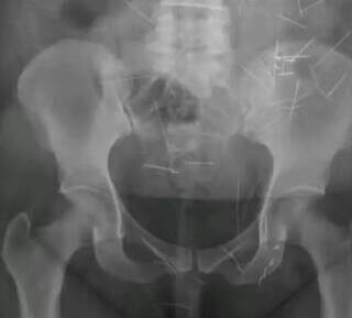 Mulher que fingiu ser crian&ccedil;a nunca foi punida em MS e seguiu aplicando golpes