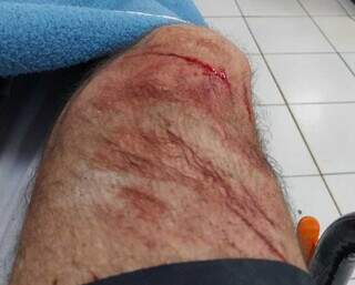Ciclista cai ao passar por ciclovia bloqueada por passarela elevada Ciclista cai ao passar por ciclovia bloqueada por passarela elevada