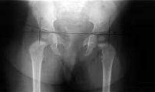 Justiça limita ressarcimento em ação que cobra cirurgia de R$ 239 mil do SUS Justiça limita ressarcimento em ação que cobra cirurgia de R$ 239 mil do SUS