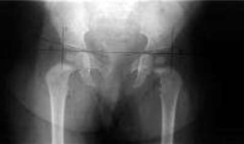 Justi&ccedil;a limita ressarcimento em a&ccedil;&atilde;o que cobra cirurgia de R$ 239 mil do SUS
