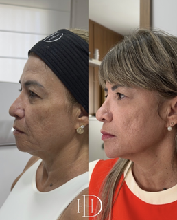 Est&eacute;tica regenerativa: o novo luxo vai al&eacute;m dos preenchedores