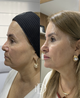 Est&eacute;tica regenerativa: o novo luxo vai al&eacute;m dos preenchedores