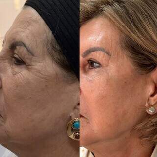 Est&eacute;tica regenerativa: o novo luxo vai al&eacute;m dos preenchedores