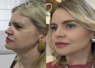 Estética regenerativa: o novo luxo vai além dos preenchedores