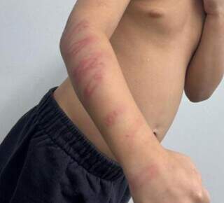 Padrasto é preso em flagrante por espancar menino de 5 anos com galho de amora Padrasto é preso em flagrante por espancar menino de 5 anos com galho de amora