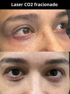 Adeus flacidez: tratamento que estimula colágeno ajuda quem busca tudo definido Adeus flacidez: tratamento que estimula colágeno ajuda quem busca tudo definido