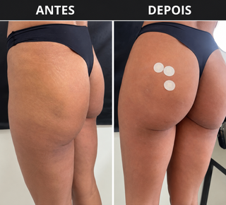 Harmonização glútea foca em contorno natural após emagrecimento com Mounjaro Harmonização glútea foca em contorno natural após emagrecimento com Mounjaro