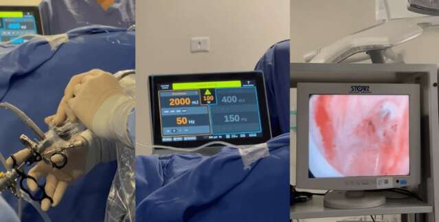Em teste, HU faz cinco cirurgias in&eacute;ditas de pr&oacute;stata a laser