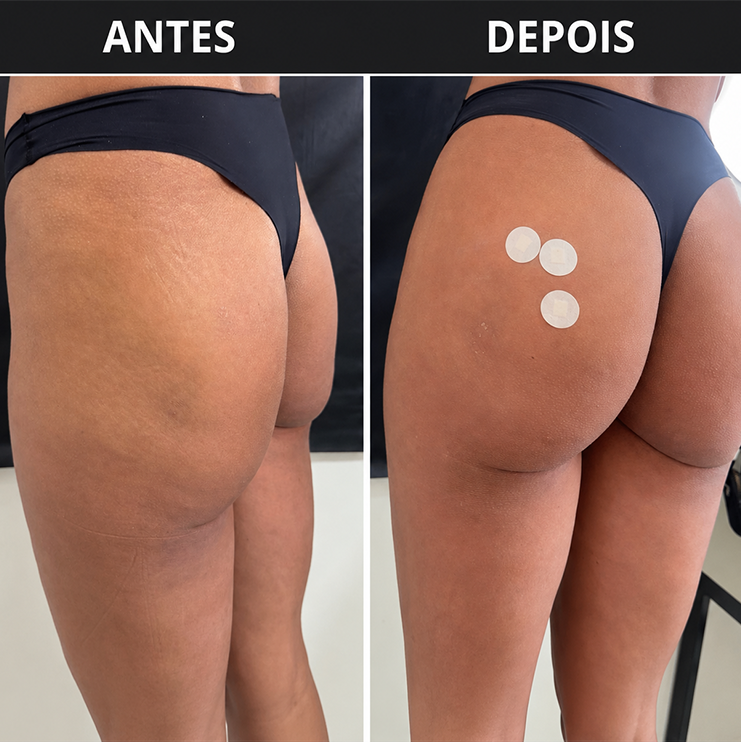 Harmonização Glútea: Foco em Naturalidade Após Emagrecimento