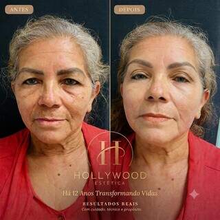 Hollywood celebra 12 anos com Consulta Estética 360° solidária Hollywood celebra 12 anos com Consulta Estética 360° solidária