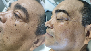 Studio Jozi Costa ajuda homens a eliminar verrugas e pintas Studio Jozi Costa ajuda homens a eliminar verrugas e pintas