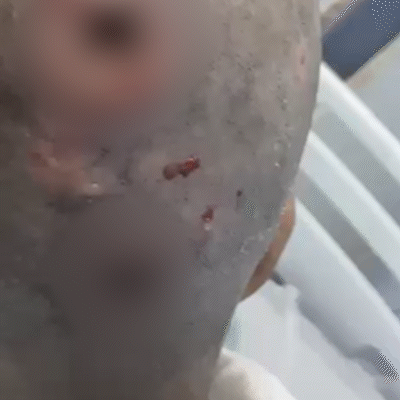 Mulher &eacute; resgatada com larvas na cabe&ccedil;a e pol&iacute;cia apura viol&ecirc;ncia sexual