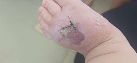 Beb&ecirc; de 1 ano &eacute; internado na Santa Casa ap&oacute;s picada de aranha e necrose no p&eacute;