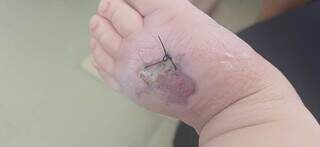 Bebê de 1 ano é internado na Santa Casa após picada de aranha e necrose no pé Bebê de 1 ano é internado na Santa Casa após picada de aranha e necrose no pé