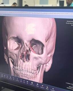 Adolescente fratura nariz e é liberado de hospital duas vezes sem cirurgia Adolescente fratura nariz e é liberado de hospital duas vezes sem cirurgia