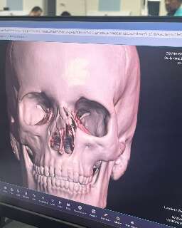 Adolescente fratura nariz e &eacute; liberado de hospital duas vezes sem cirurgia