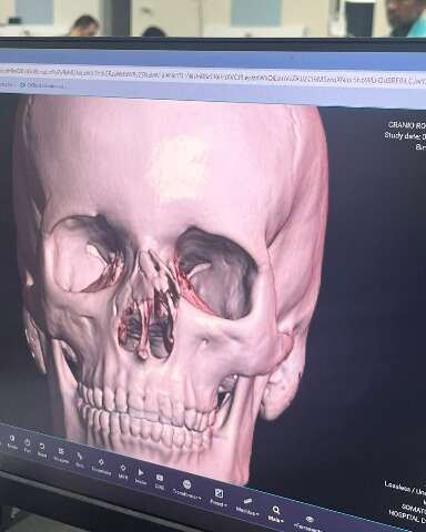 Adolescente fratura nariz e &eacute; liberado de hospital duas vezes sem cirurgia