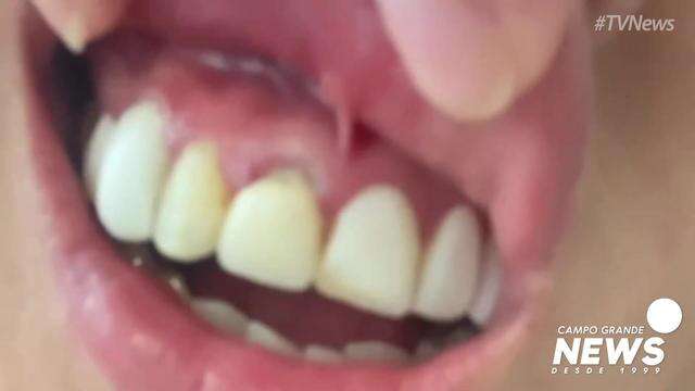 Paciente descobre que dentista implantou dente comprado na Shopee
