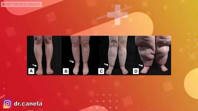 Isso não é celulite! Lipedema pode ser grave, mas tem tratamento